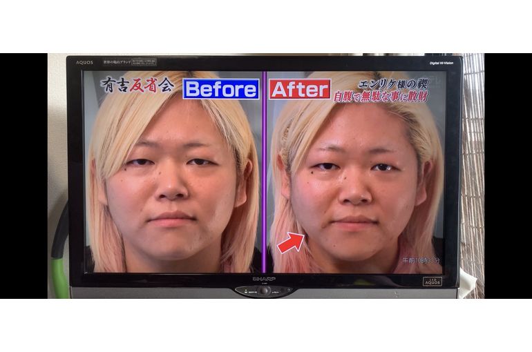 小顔　効果　すぐ変わる